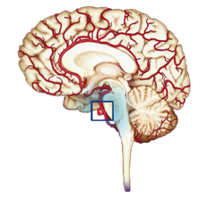 Brain Aneurysm